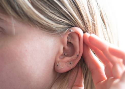  Auriculotherapy and sleep: ear points help you sleep better
