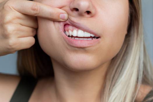  Bílé dásně: co to je, příčiny a léčba