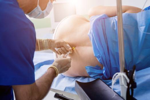  Epidurální anestezie: co to je, kdy je indikována a možná rizika